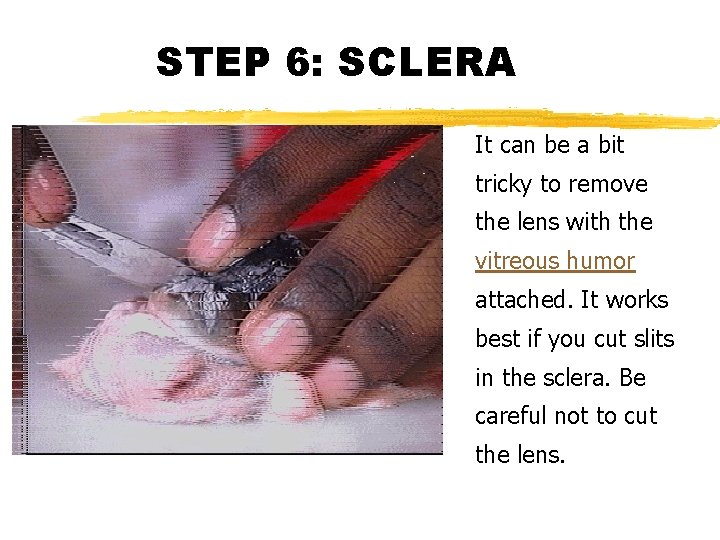 STEP 6: SCLERA It can be a bit tricky to remove the lens with