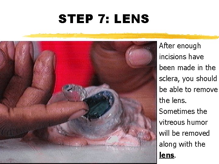 STEP 7: LENS After enough incisions have been made in the sclera, you should