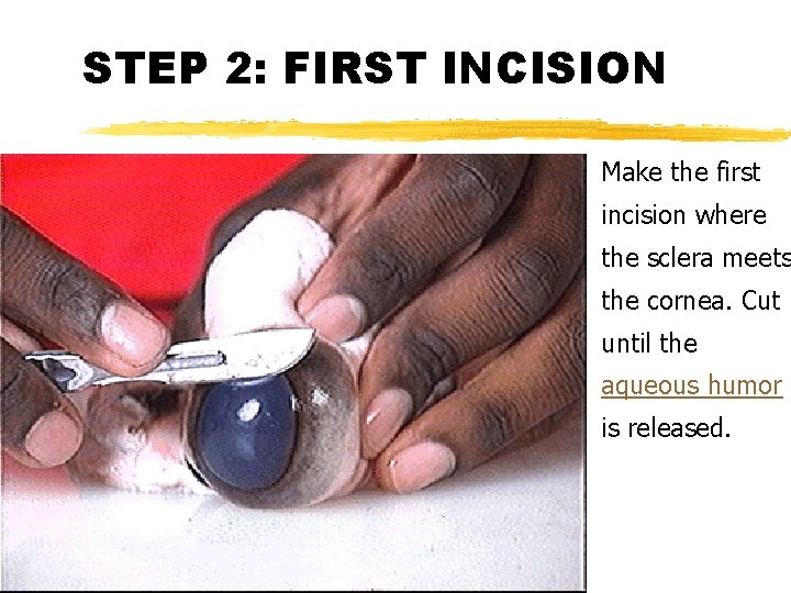 STEP 2: FIRST INCISION Make the first incision where the sclera meets the cornea.