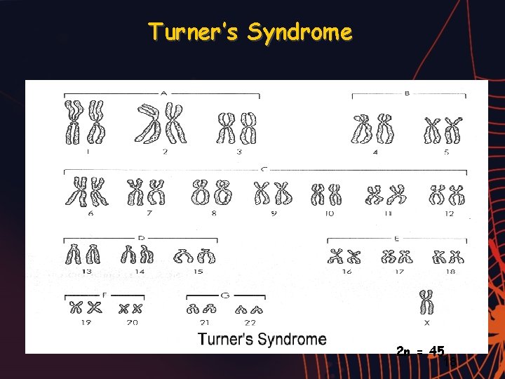 Turner’s Syndrome 2 n = 45 18 