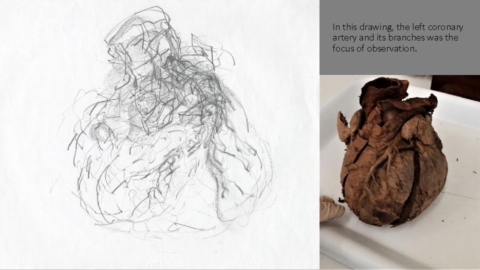 In this drawing, the left coronary artery and its branches was the focus of
