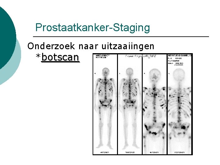 Prostaatkanker-Staging Onderzoek naar uitzaaiingen *botscan 