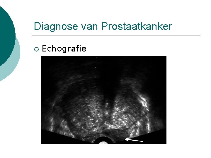 Diagnose van Prostaatkanker ¡ Echografie 