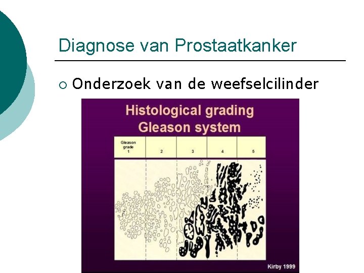 Diagnose van Prostaatkanker ¡ Onderzoek van de weefselcilinder 