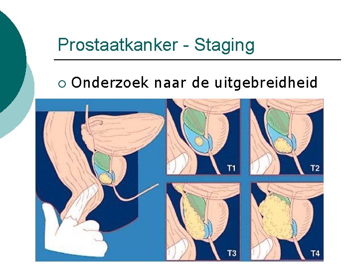 Prostaatkanker - Staging ¡ Onderzoek naar de uitgebreidheid 