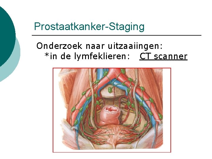 Prostaatkanker-Staging Onderzoek naar uitzaaiingen: *in de lymfeklieren: CT scanner 