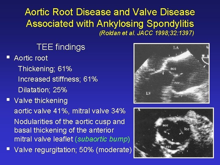 Aortic Root Disease and Valve Disease Associated with Ankylosing Spondylitis (Roldan et al. JACC Aortic Root Disease and Valve Disease Associated with Ankylosing Spondylitis (Roldan et al. JACC