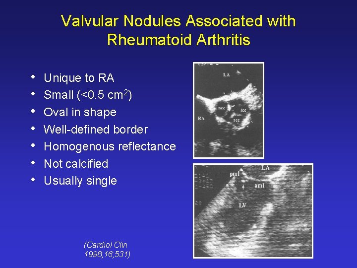 Valvular Nodules Associated with Rheumatoid Arthritis • • Unique to RA Small (<0. 5 Valvular Nodules Associated with Rheumatoid Arthritis • • Unique to RA Small (<0. 5