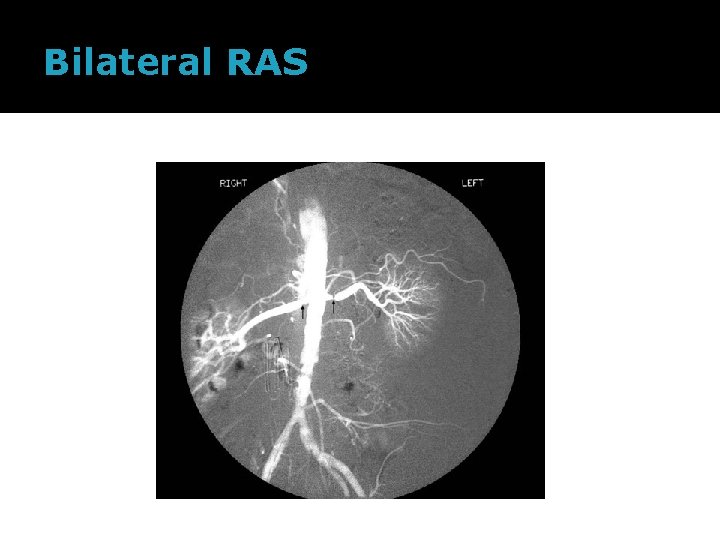 Bilateral RAS 