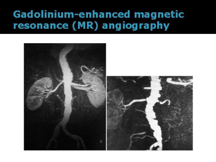 Gadolinium-enhanced magnetic resonance (MR) angiography 