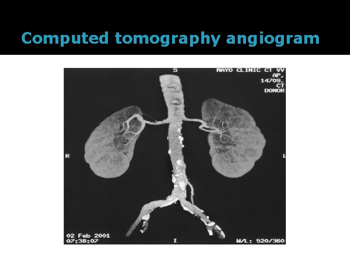 Computed tomography angiogram 