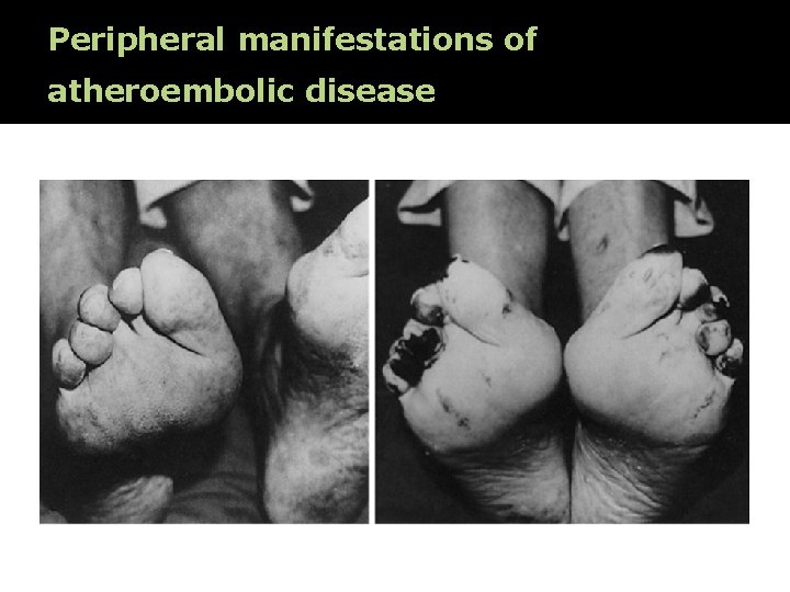 Peripheral manifestations of atheroembolic disease 