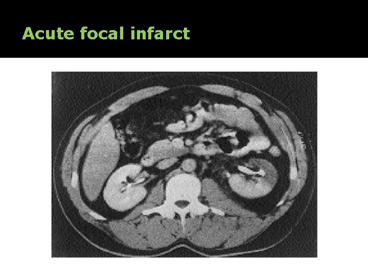 Acute focal infarct 