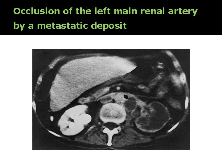 Occlusion of the left main renal artery by a metastatic deposit 