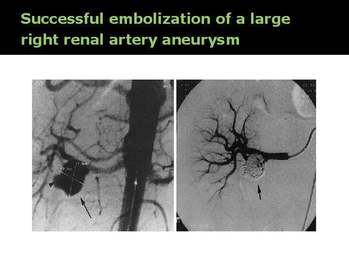 Successful embolization of a large right renal artery aneurysm 