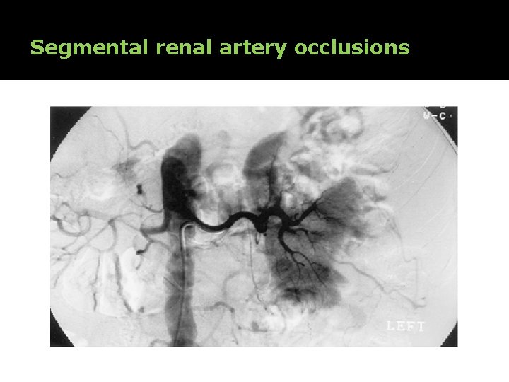 Segmental renal artery occlusions 