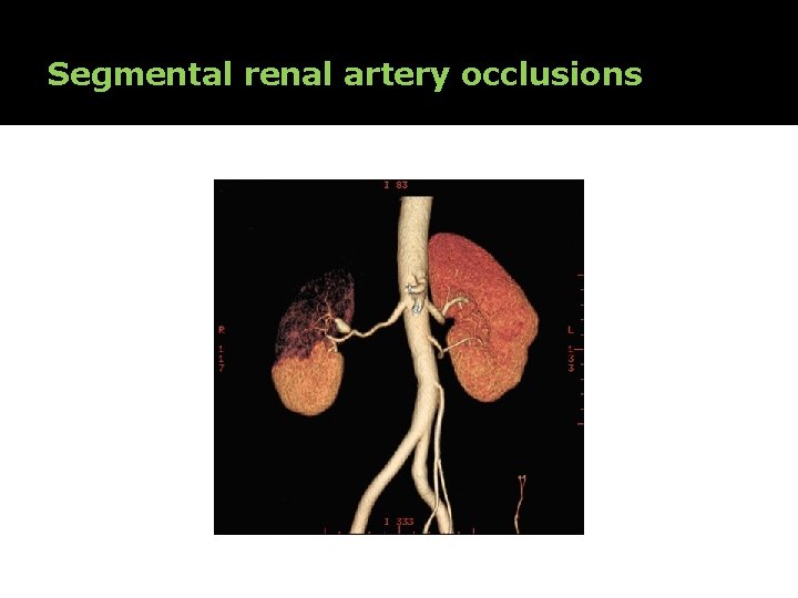 Segmental renal artery occlusions 