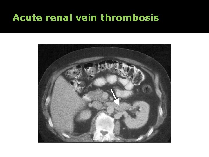 Acute renal vein thrombosis 