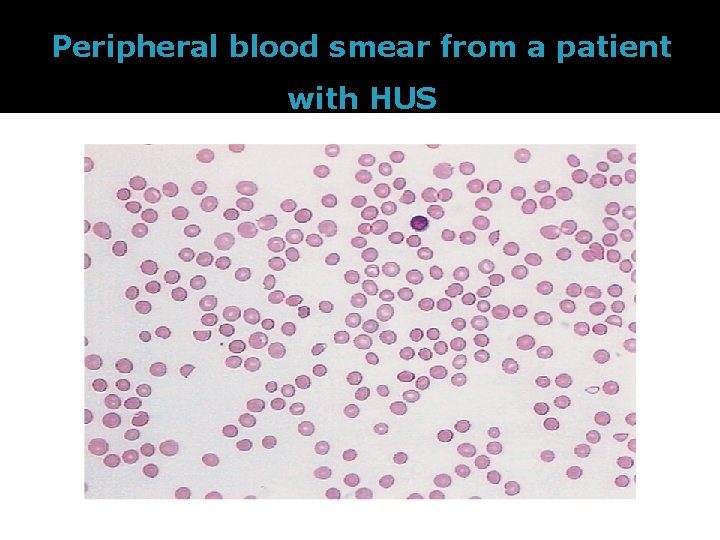Peripheral blood smear from a patient with HUS 
