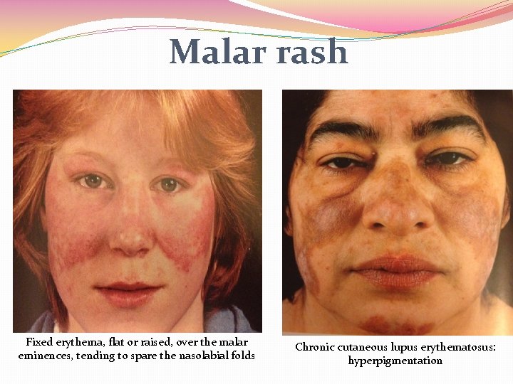 Malar Rash Pattern Systemic Lupus Erythematosus Challenges and Options Grand Rounds