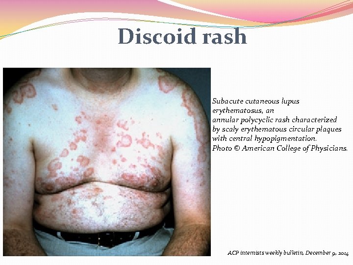 Systemic Lupus Erythematosus Challenges and Options Grand Rounds