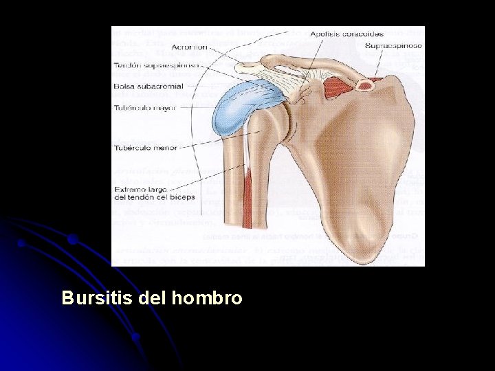 Bursitis del hombro 