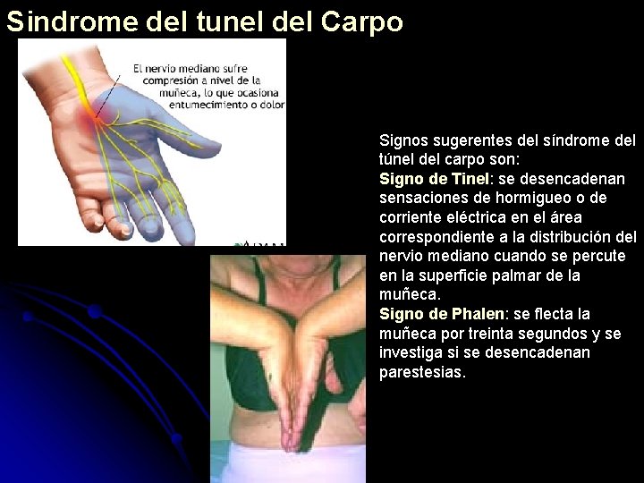 Sindrome del tunel del Carpo Signos sugerentes del síndrome del túnel del carpo son: