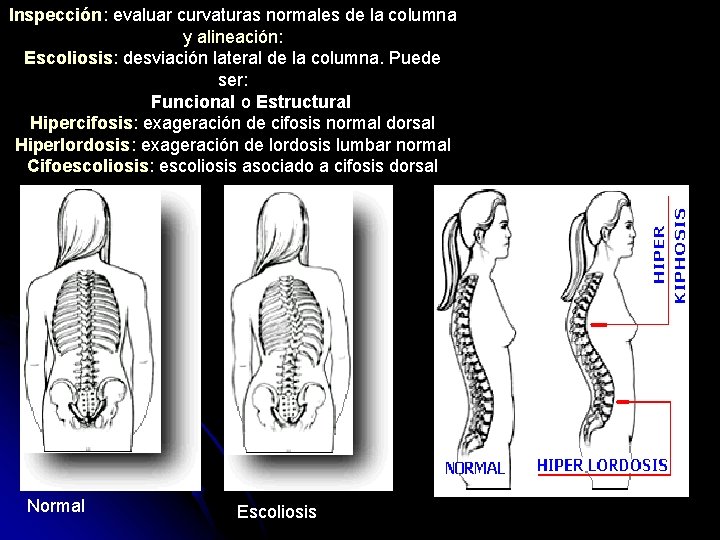 Inspección: evaluar curvaturas normales de la columna y alineación: Escoliosis: desviación lateral de la