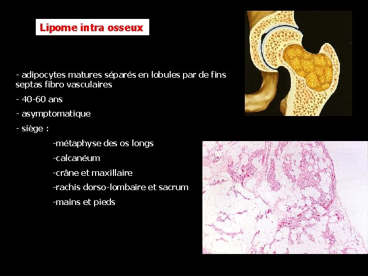 Lipome intra osseux - adipocytes matures séparés en lobules par de fins septas fibro