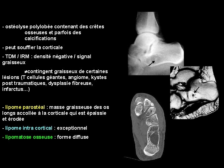 - ostéolyse polylobée contenant des crêtes osseuses et parfois des calcifications - peut souffler