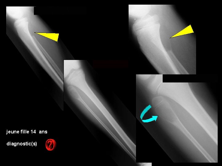 jeune fille 14 ans diagnostic(s) 