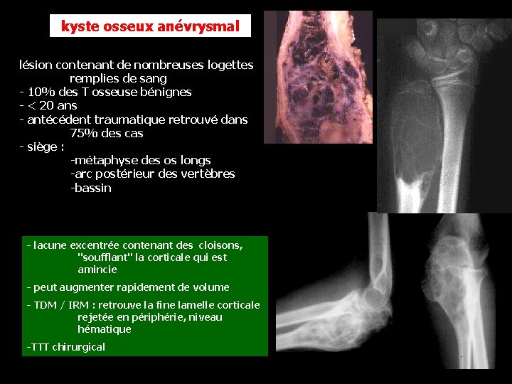 kyste osseux anévrysmal lésion contenant de nombreuses logettes remplies de sang - 10% des