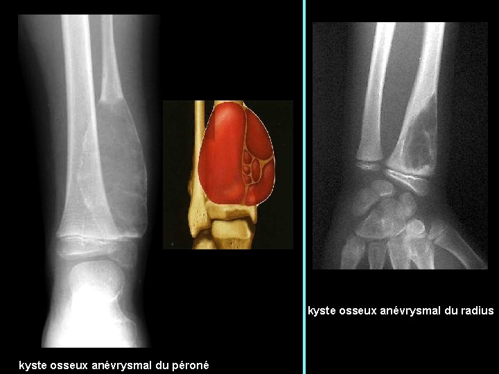 kyste osseux anévrysmal du radius kyste osseux anévrysmal du péroné 