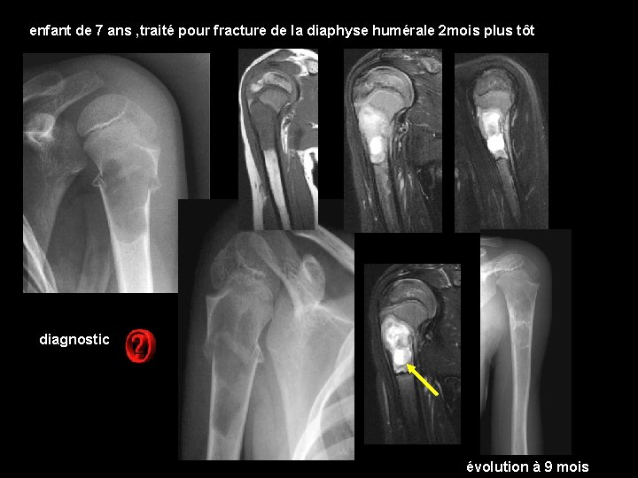 enfant de 7 ans , traité pour fracture de la diaphyse humérale 2 mois