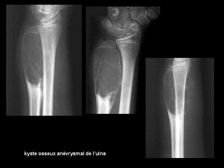 kyste osseux anévrysmal de l'ulna 