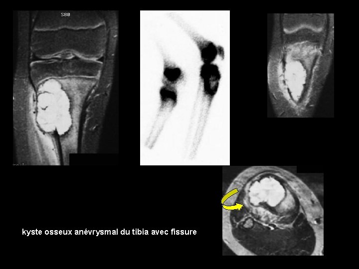 kyste osseux anévrysmal du tibia avec fissure 