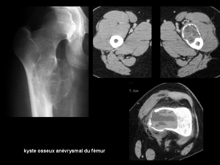 kyste osseux anévrysmal du fémur 