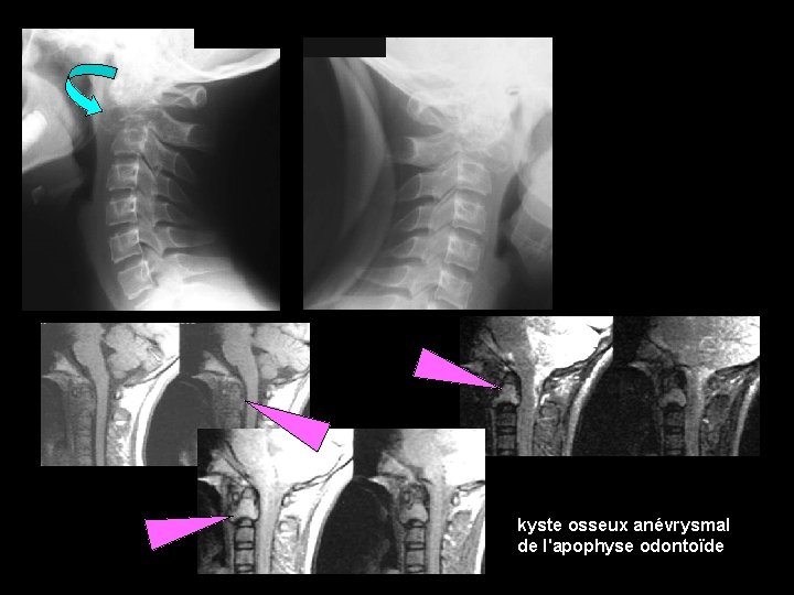 kyste osseux anévrysmal de l'apophyse odontoïde 