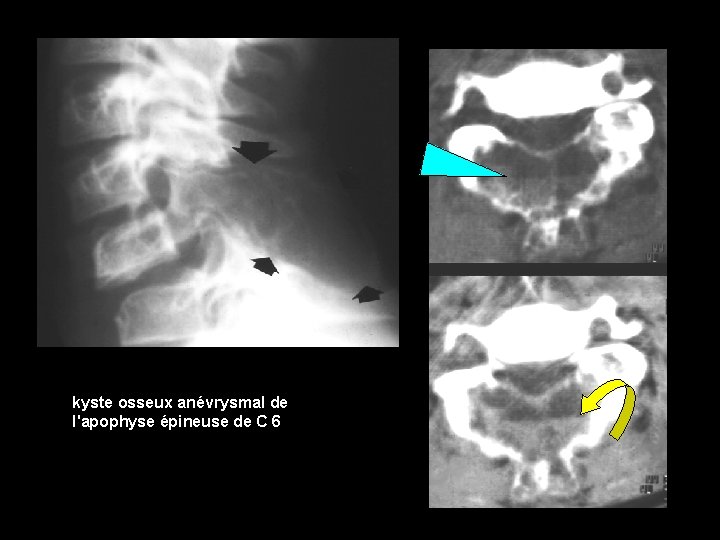 kyste osseux anévrysmal de l'apophyse épineuse de C 6 