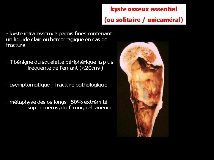 kyste osseux essentiel (ou solitaire / unicaméral) - kyste intra osseux à parois fines