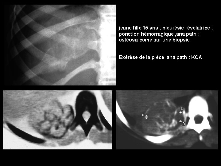 jeune fille 15 ans ; pleurésie révélatrice ; ponction hémorragique , ana path :