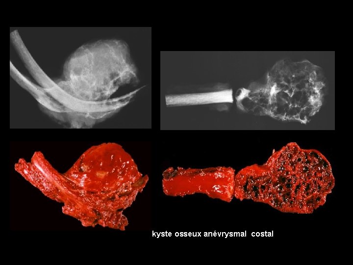 kyste osseux anévrysmal costal 