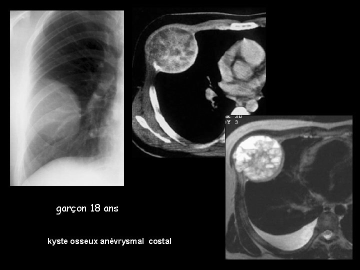 garçon 18 ans kyste osseux anévrysmal costal 