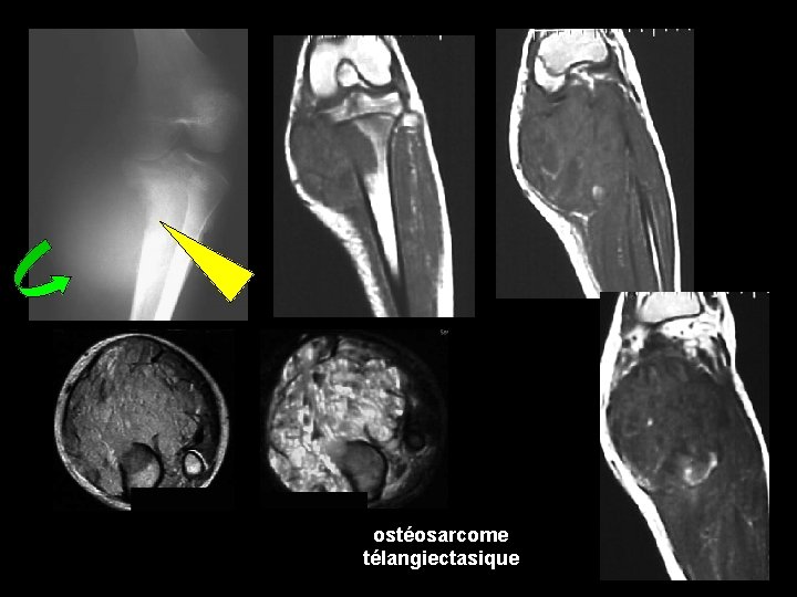 ostéosarcome télangiectasique 