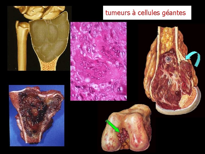 tumeurs à cellules géantes 