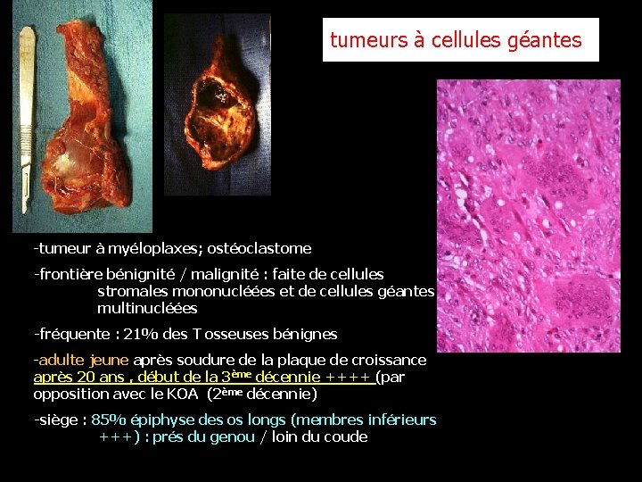 tumeurs à cellules géantes -tumeur à myéloplaxes; ostéoclastome -frontière bénignité / malignité : faite