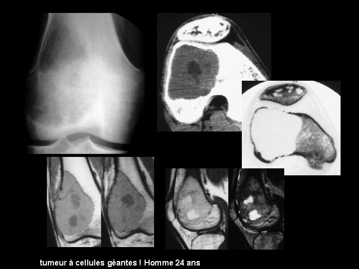 tumeur à cellules géantes ! Homme 24 ans 