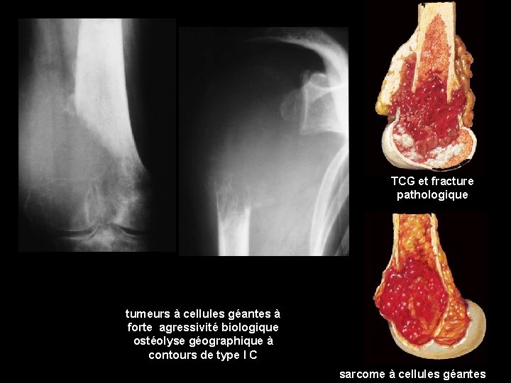 TCG et fracture pathologique tumeurs à cellules géantes à forte agressivité biologique ostéolyse géographique