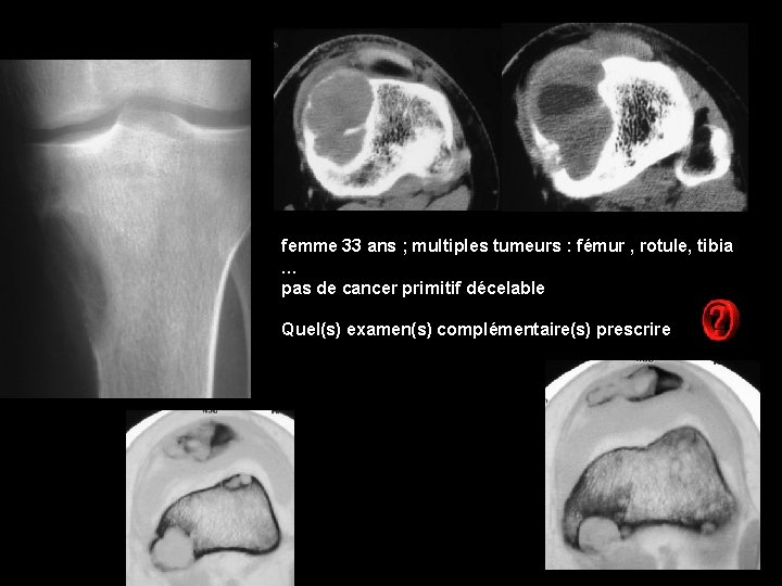 femme 33 ans ; multiples tumeurs : fémur , rotule, tibia … pas de