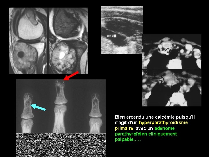 Bien entendu une calcémie puisqu'il s'agit d'un hyperparathyroïdisme primaire , avec un adénome parathyroïdien